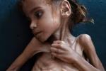 «امل‌حسین» دختر 7 ساله یمنی دیگر لبخند نمی‌زند!