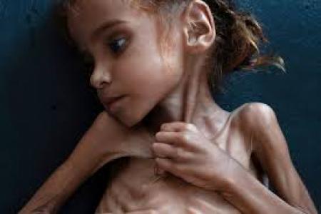 «امل‌حسین» دختر 7 ساله یمنی دیگر لبخند نمی‌زند!
